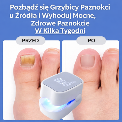 PureNail Pro™ Laserowa precyzja, widoczne efekty